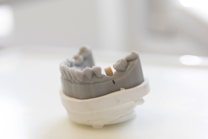 Zahnarztpraxis Werderstrasse - Gebiss Implantat